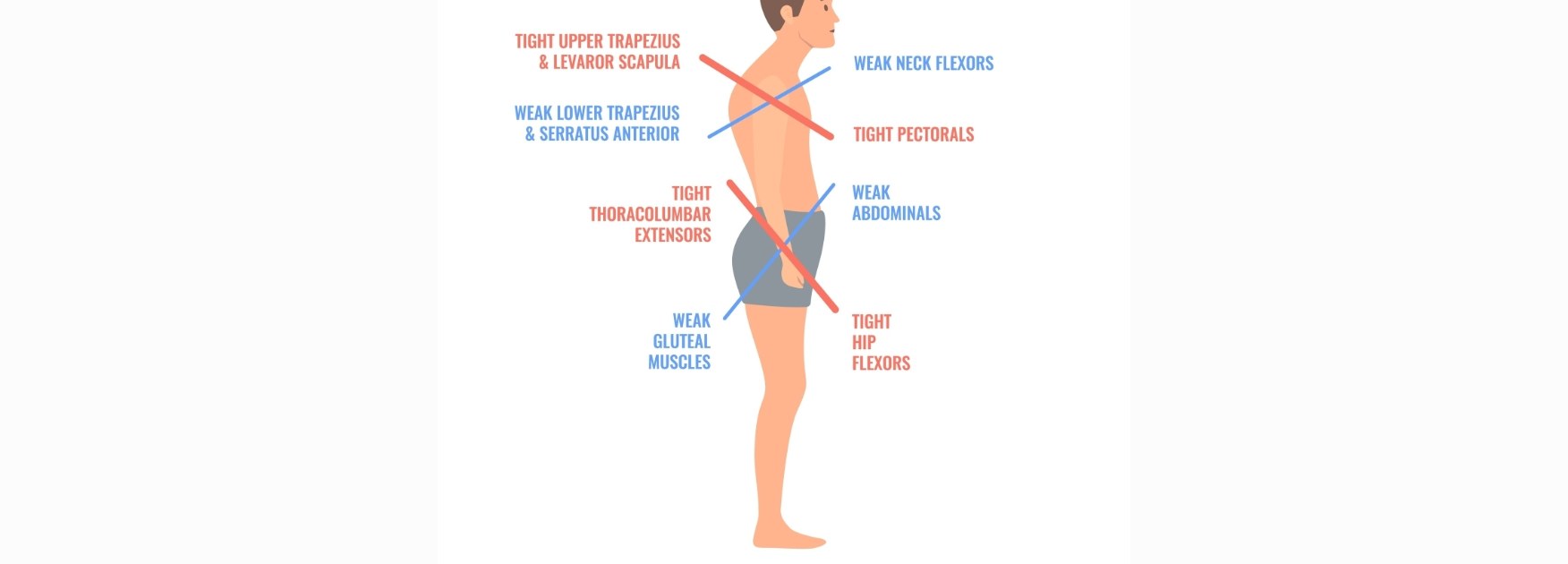 Schéma upper cross syndrome — muscles hypertoniques et inhibés