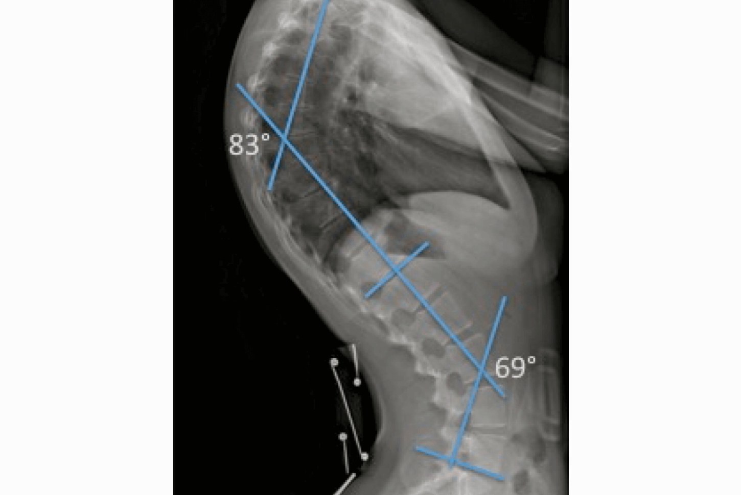 Radiographie de profil rachis avec mesures Cobb 83° et 69°