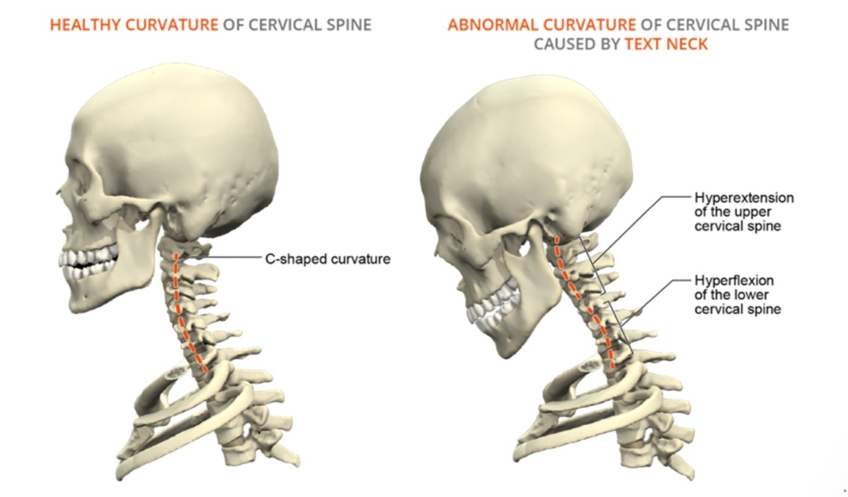 Radiographie comparative — lordose cervicale normale vs courbure cervicale anormale en Text Neck