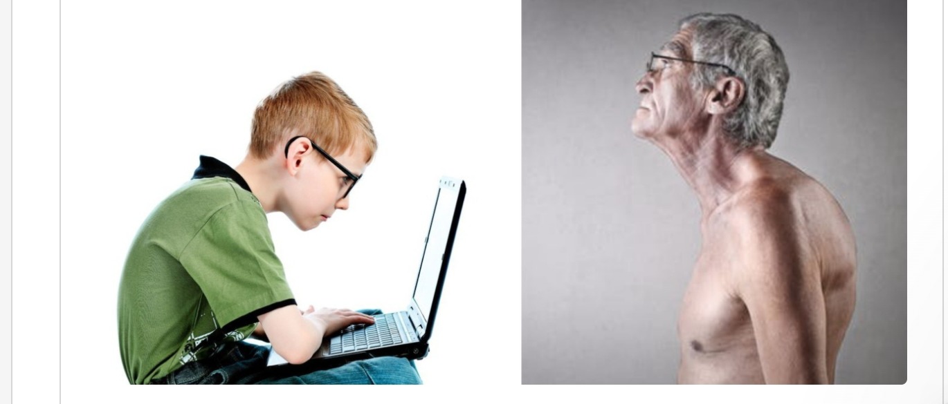 Forward Head Posture — comparaison posture neutre vs tête en avant