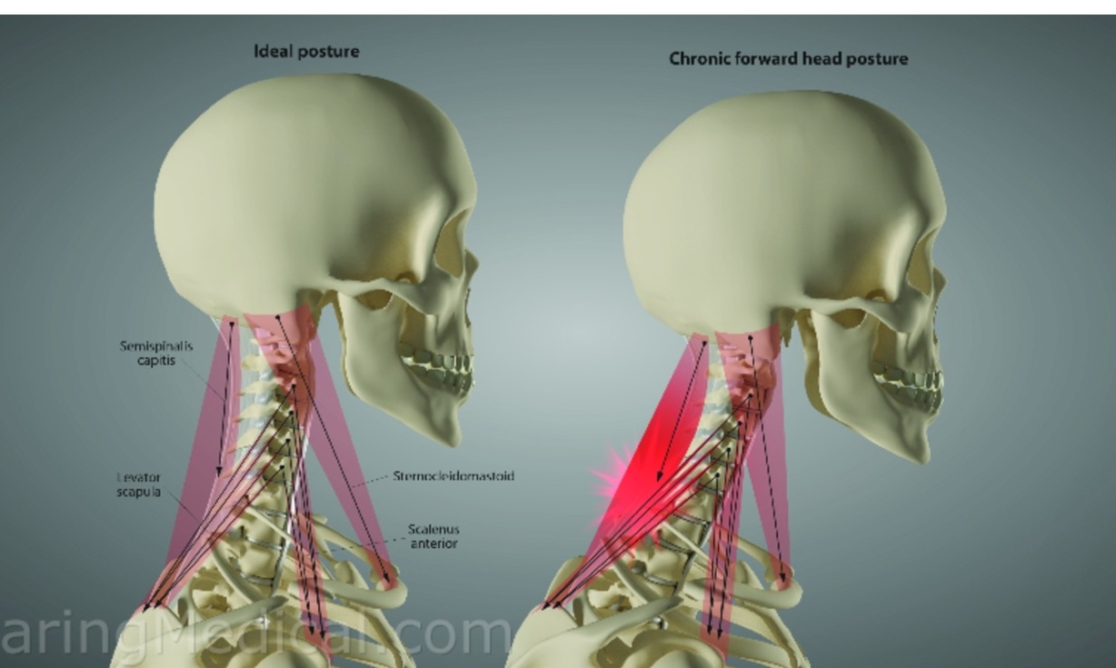 Comparaison posture idéale vs FHP chronique — tension musculaire et modifications structurelles